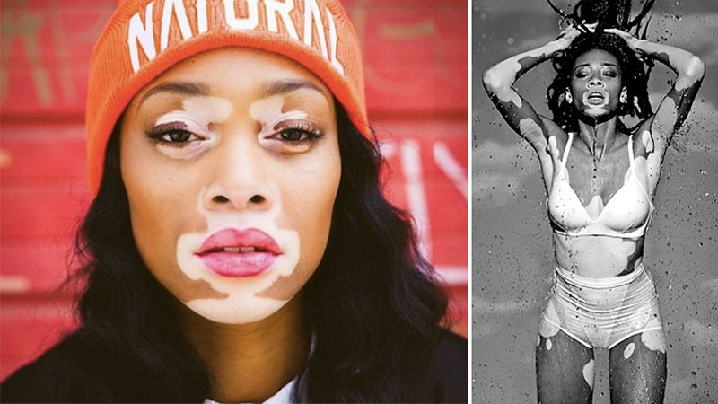 Winnie Harlow